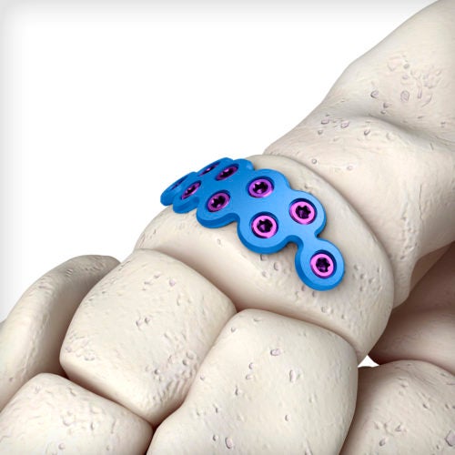 Navicular Fracture Plate